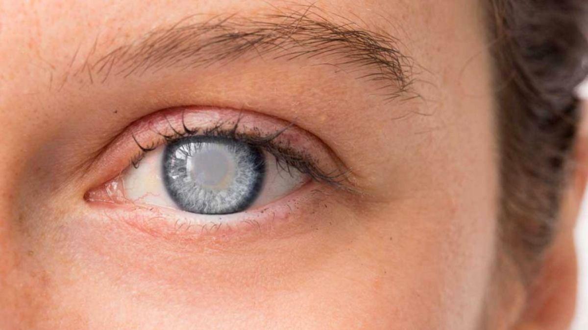 علماء يجدون دواءً واعدًا لعلاج العمى الخلقي لدى الأطفال!