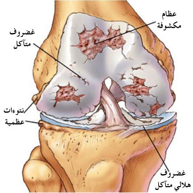 غضروف الركبة 