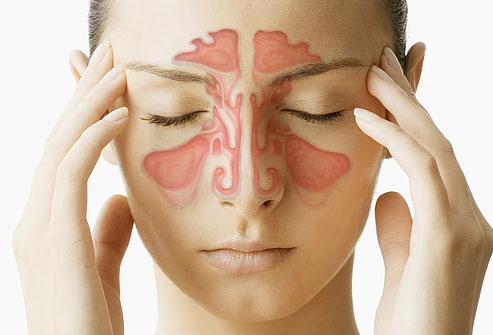 webmd_composite_image_of_sinuses الصداع من التهاب الجيوب