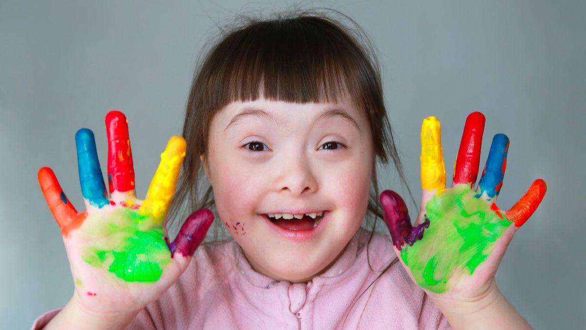 متلازمة داون