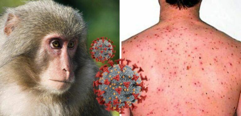 جدري القرود يتفشى في العالم...أسبابه أعراضه الوقاية منه والعلاج