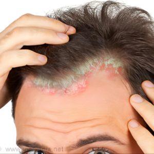 طرق علاج صدفية الشعر
