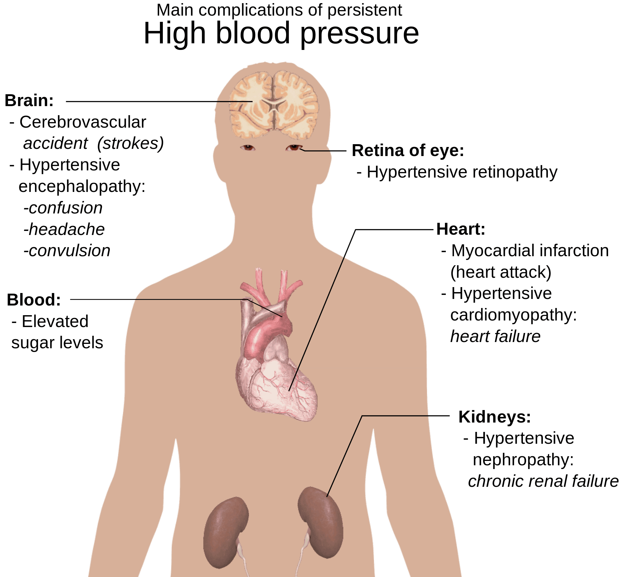 خفض ضغط الدم الإصابة بأزمة قلبية