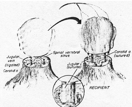 صورة توضيحية لكيفية ربط الرأس بالبدن طبياً. زراعة رأس في جسد ميت