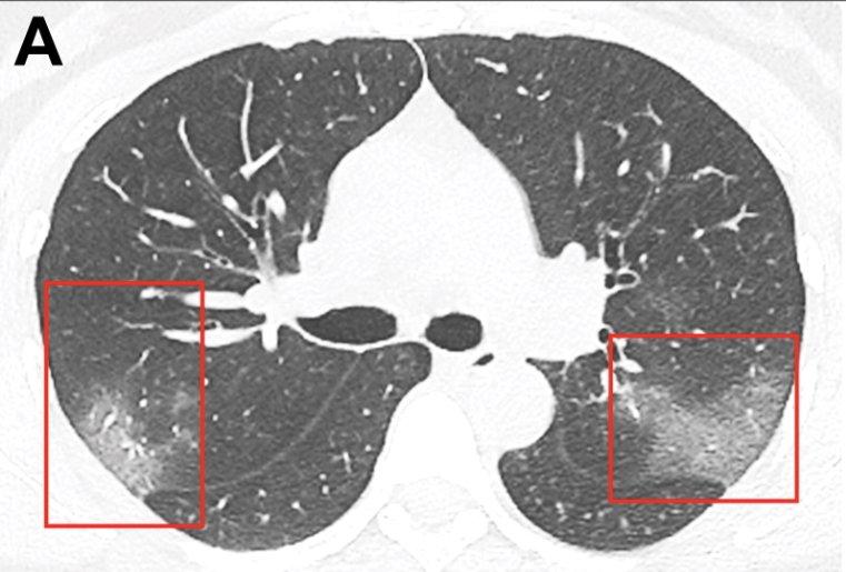 Figure A: CT scan of a coronavirus from a patient in China showing ground glass lesions in the lungs. Images courtesy of the Radiological Society of North America. For larger images and more details on the scan, view the original article at https://pubs.rsna.org/doi/10.1148/radiol.2020200236
