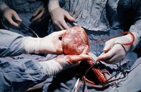 صورة من عملية نقل القلب