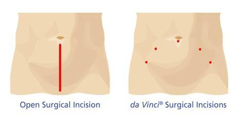 prostatectomy-incision-comparison-en